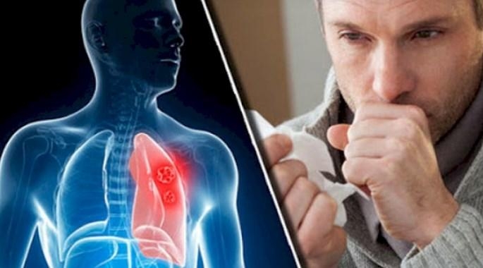 Koronavirus zamanı immuniteti və ağciyəri möhkəmləndirmək üçün RESEPT
