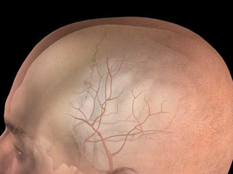 Epidural hematomalar