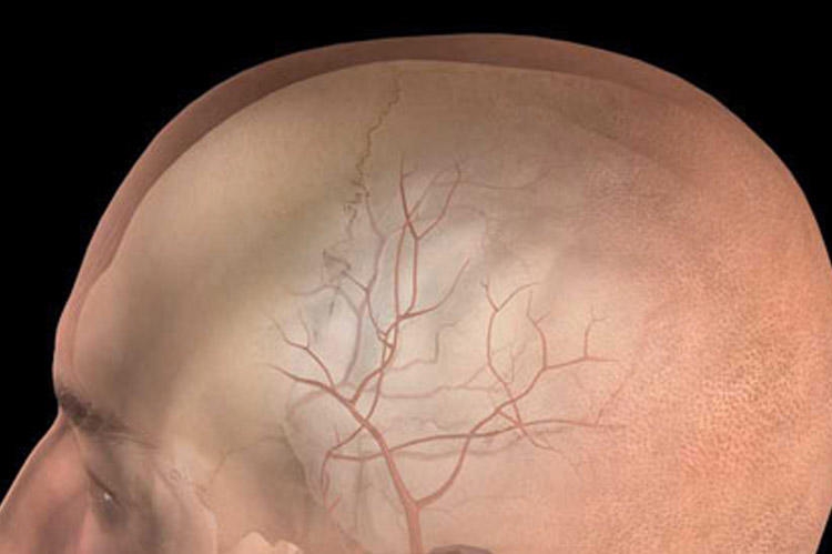 Epidural hematomalar