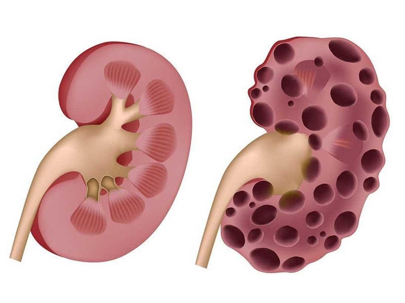 Böyrək polikistozu