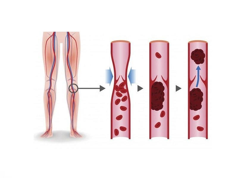 Həkimlər təhlükəli trombozun əlamətini açıqladı - Öldürə bilər