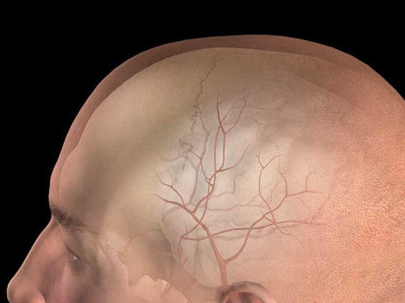 Epidural hematomalar