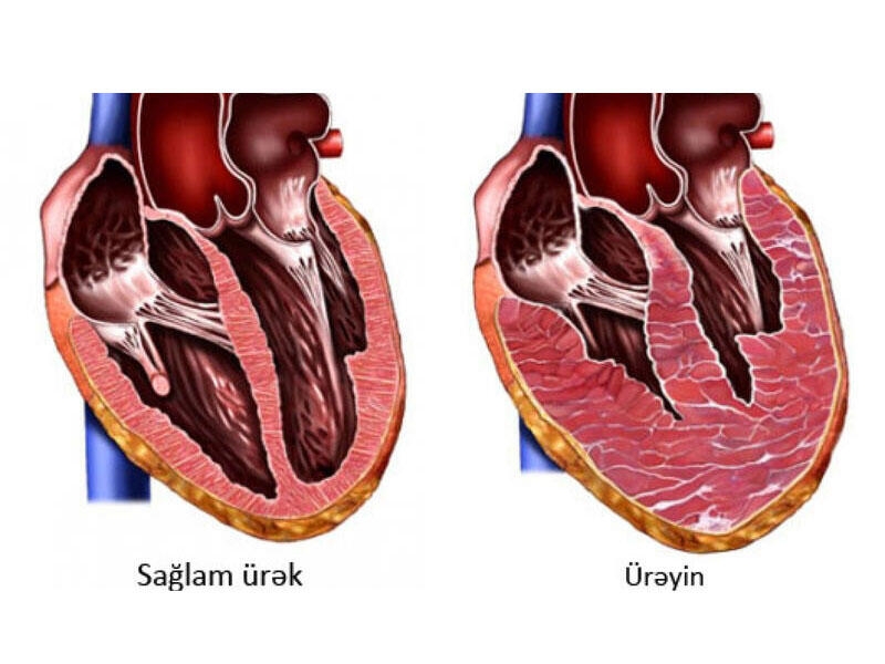 Ürək böyüsə, nə baş verər? - TƏHLÜKƏLİ SİMPTOM