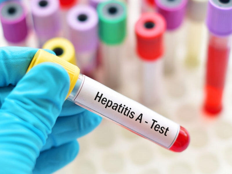Ötən il Azərbaycanda hepatit xəstəliyindən 62 nəfər ölüb