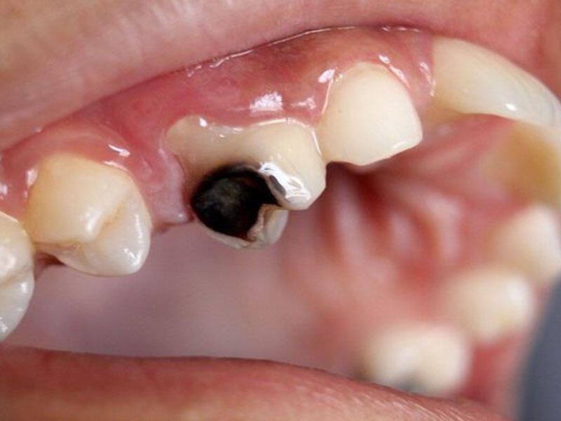 Çürük dişlər ürəyi xəstə edir - İnfarkt riski