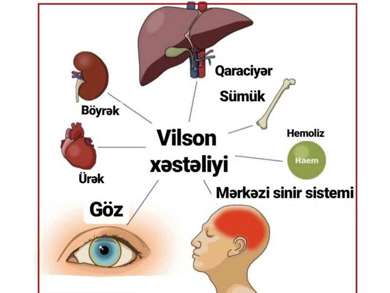 Vilson xəstəliyi nədir?