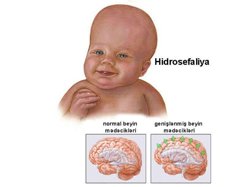 Körpə uşaqlarda hidrosefaliya xəstəliyi