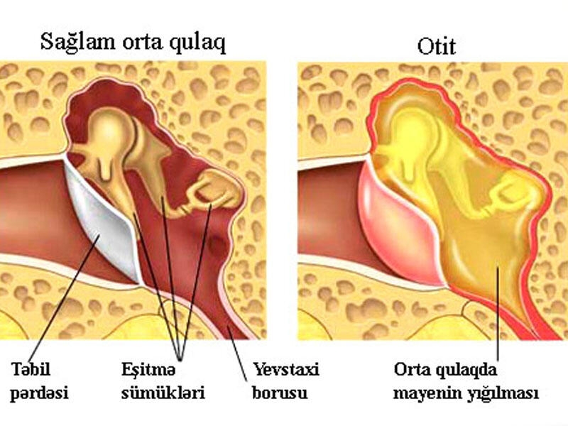 Otit - qulaq iltihabı