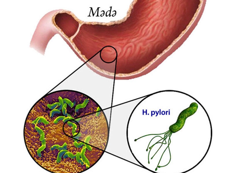 Mədə mikrobu hansı fəsadlara yol aça bilər?