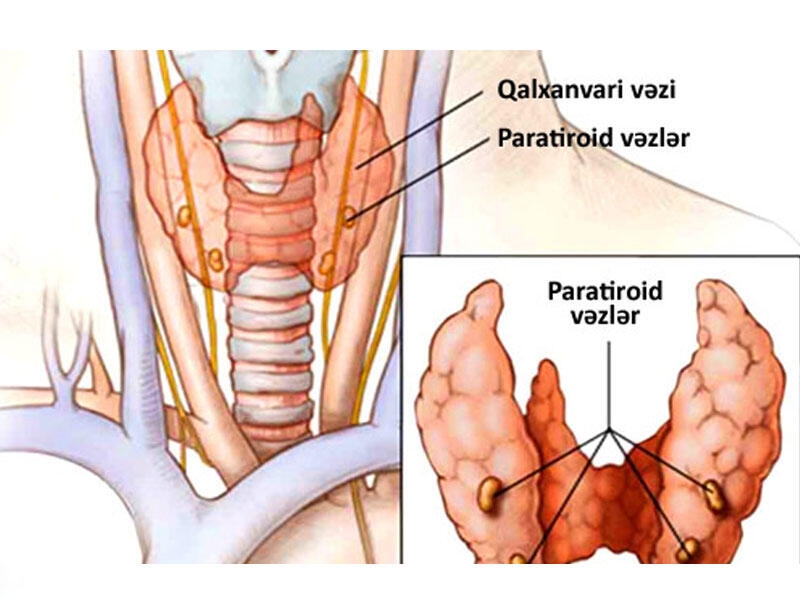 Kövrək sümüklər, böyrək daşları, qəbizlik. Bu hiperparatireoz ola bilər!