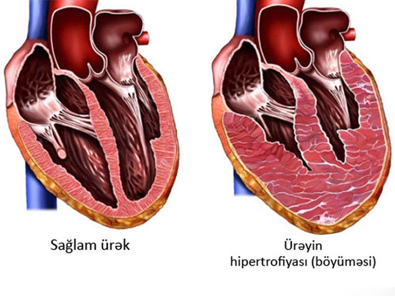 Ürəyin böyüməsi - təhlükəli simptom