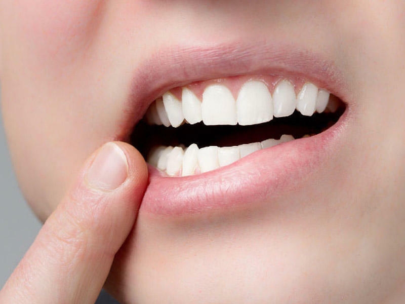 Xarab dişlər bu ağır xəstəliyin riskini artırır