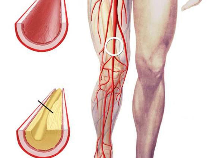 Aşağı ətraf arteriyalarının aterosklerozu