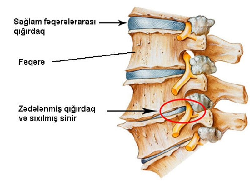 Osteoxondroz və onun müalicəsi