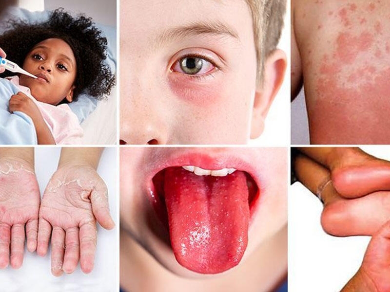 Uşaqlarda multisistemli iltihab sindromu - İnfeksiiyalardan sonra baş qaldırır
