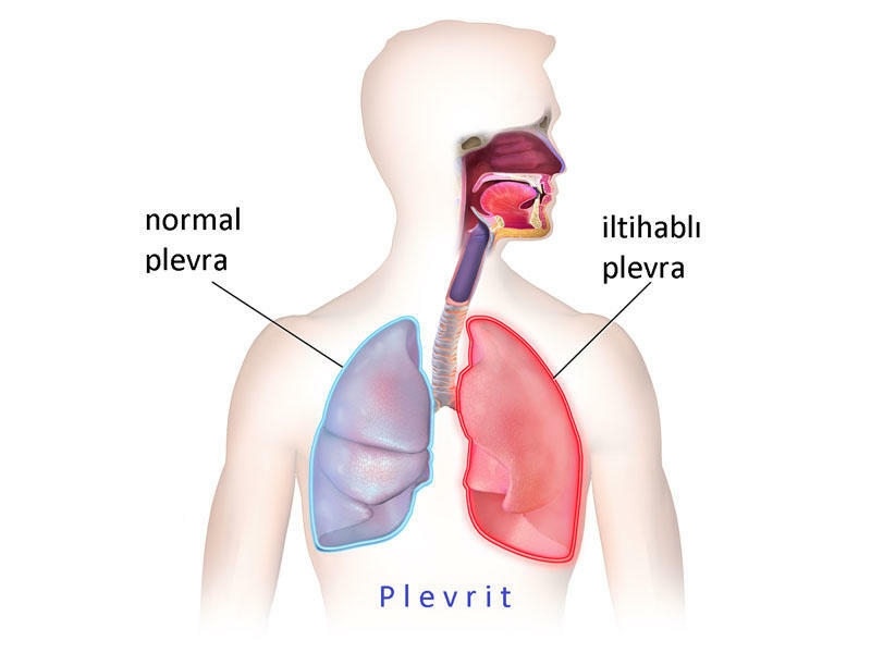 Plevrit və plevral möhtəviyyat