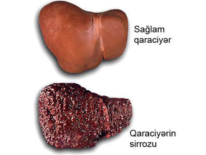 Xəstə qaraciyərin SOS siqnalları