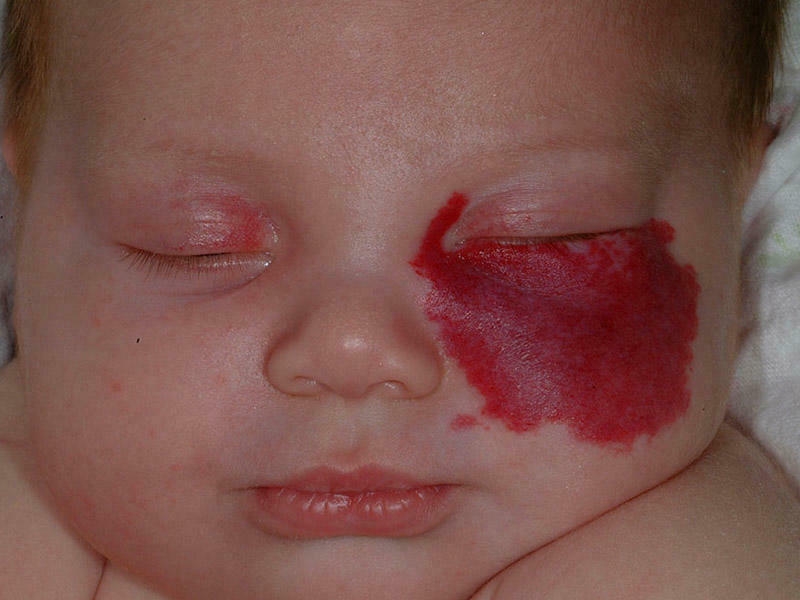 Hemangioma – Pir nişanəsi