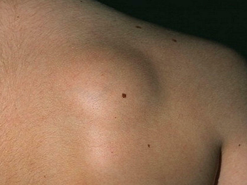 Lipoma