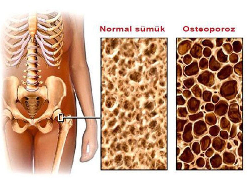 Qadınlarda osteoporoz xəstəliyi və klimaks