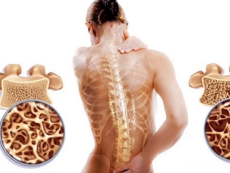 Osteoporoz - sümüklərin əriməsinə qarşı Alman metodu