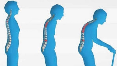 Osteoporoz: 50 yaşdan sonra hər üç qadından, hər beş kişidən biri bu xəstəlikdən əziyyət çəkir