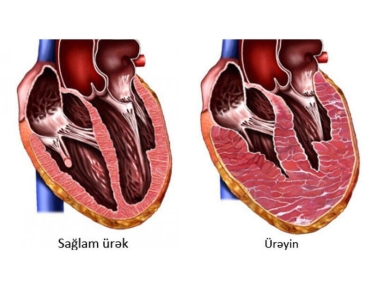 Ürək böyüsə, nə baş verər? - TƏHLÜKƏLİ SİMPTOM