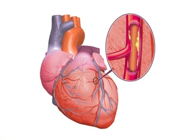 Ürəyin işemik (koronar) xəstəliyi