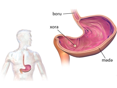 Mədə və onikibarmaq bağırsaq xorasının ağırlaşmaları