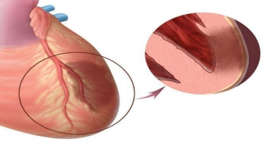 Ayaqüstü keçirilən infarkt - Tromb damarda qopanda nə baş verir?