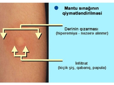 Mantu sınağı