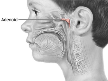 Böyümüş adenoidlər hansı fəsadlar törədir?