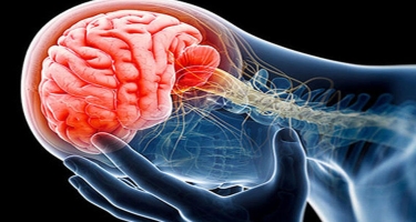 Beyin silkələnməsinin simptomları -  Nevroloqdan