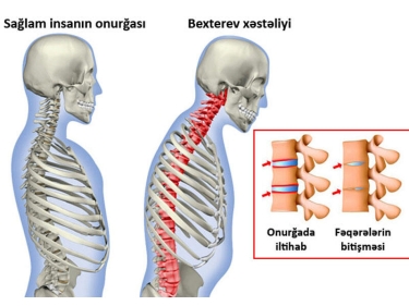 Bexterev xəstəliyi. Hərəkətsiz onurğa