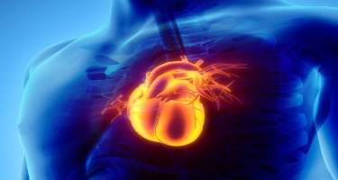 Həkim-kardioloq: Ürək tutmasının əsas səbəbi miokard infarktıdır