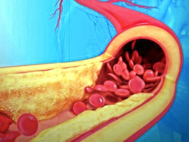 Qanı şəkər, lipid və xolesterindən təmizləyən vasitə - Damarlarınız güzgü kimi olacaq