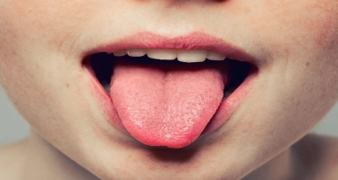 Dilin iltihabı – qlossit