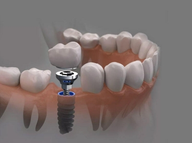 Diş implantı