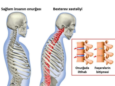 Bexterev xəstəliyi. Hərəkətsiz onurğa