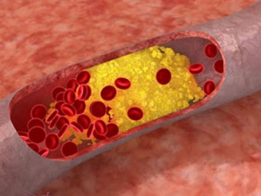 Damarların xolesterondan təbii üsulla təmizlənməsi