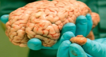 Beyin xərçəngi üçün ən xarakterik simptom - AÇIQLANDI