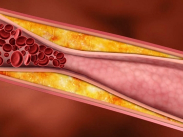 Bizi öldürən XOLESTEROL