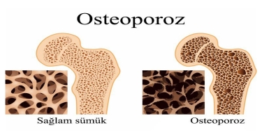 Osteoporoz - 