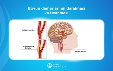 Bu müalicə də icbari tibbi sığortaya daxildir