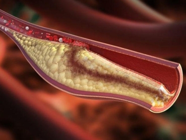 Xolesterin və trombu əritmək üçün necə qidalanmaq lazımdır?