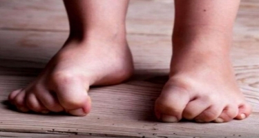 Narahat ayaqlar sindromu üçün RESEPT - Ağrıdan yata bilməyənlərə - VİDEO